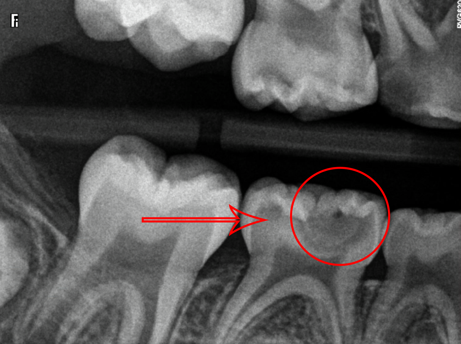 tooth-cavity-xray