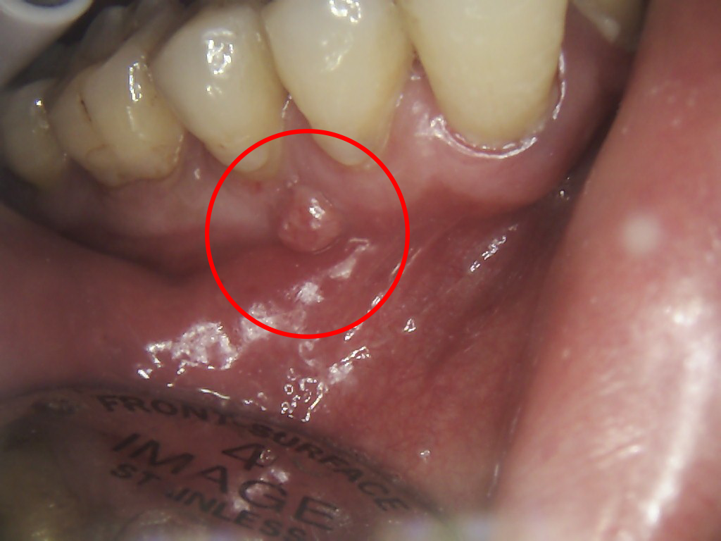 Tooth Abscess Stages Pictures And Treatment Options Web Dmd
