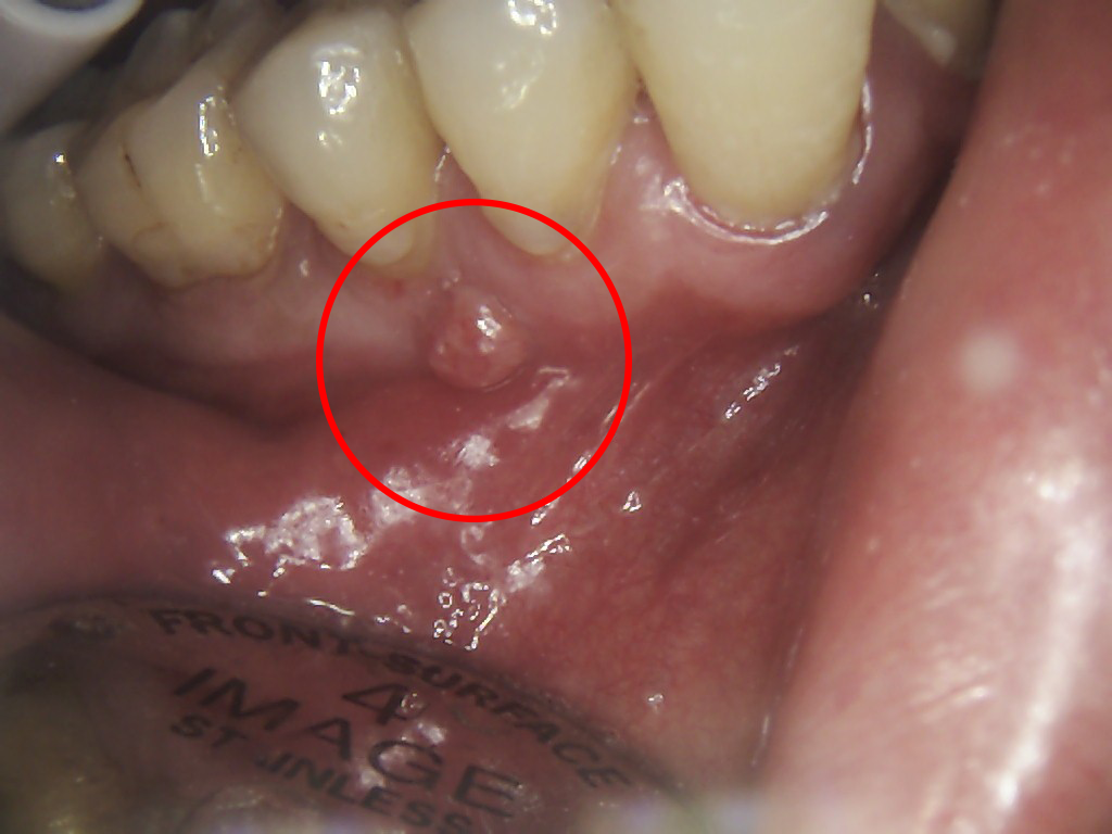 Tooth Abscess Stages Pictures And Treatment Options Web DMD