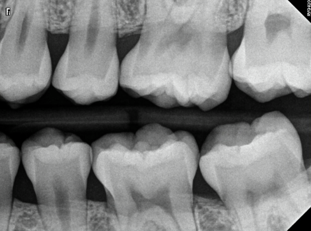 X-Ray of Healthy Teeth with no Cavities 
