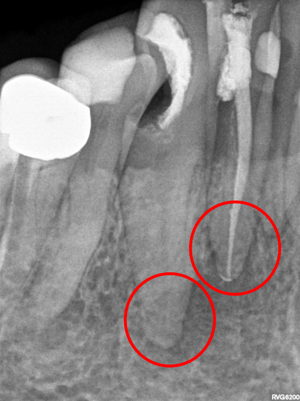 X-Rays of Teeth With Abscess