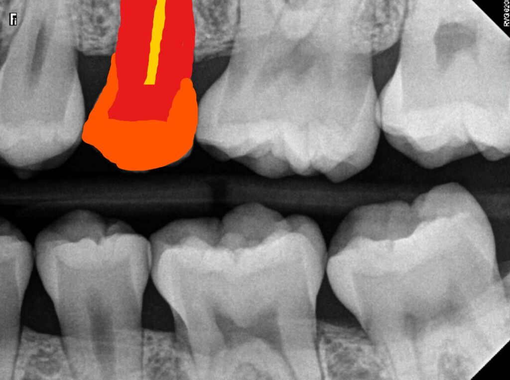 X-Ray of Healthy Teeth with no Cavities (Marked Up)