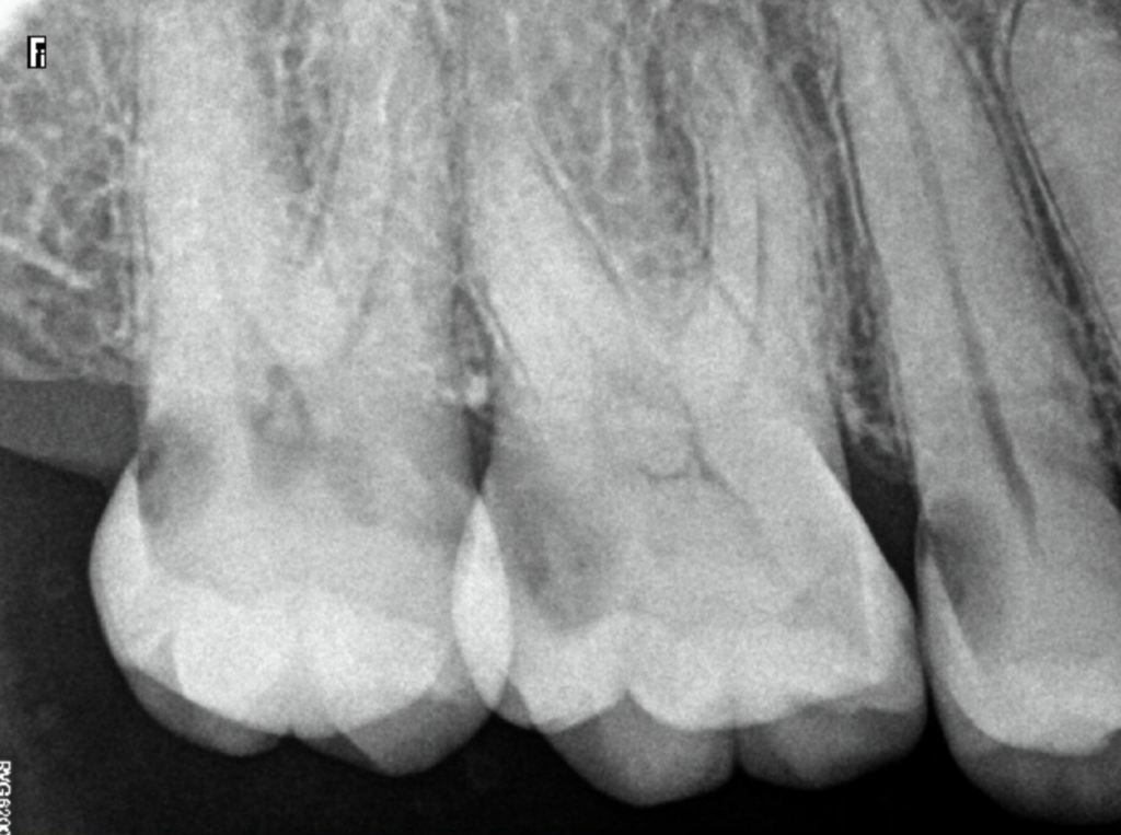 X-Rays of Teeth With Severe Cavities