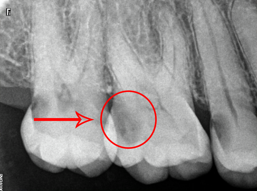X-Rays of Teeth With Severe Cavities Marked