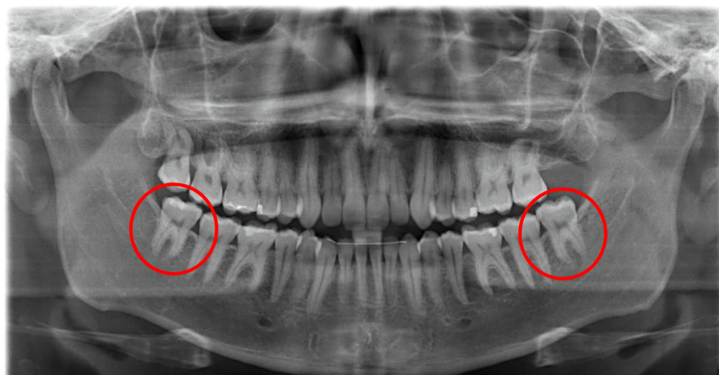 Non-Impacted Wisdom Teeth X-Ray