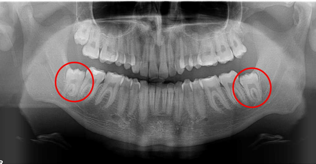 Partially Impacted Wisdom Teeth X-Ray