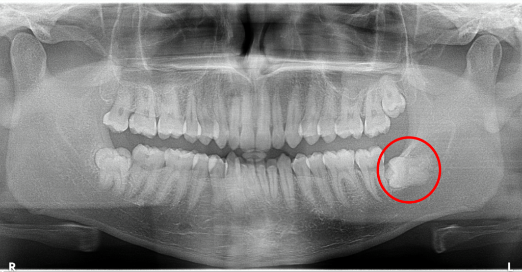 Fully Impacted Wisdom Teeth X-Ray