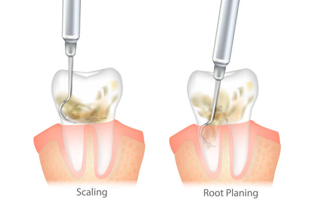 Disadvantages and Advantages of Deep Cleaning Teeth