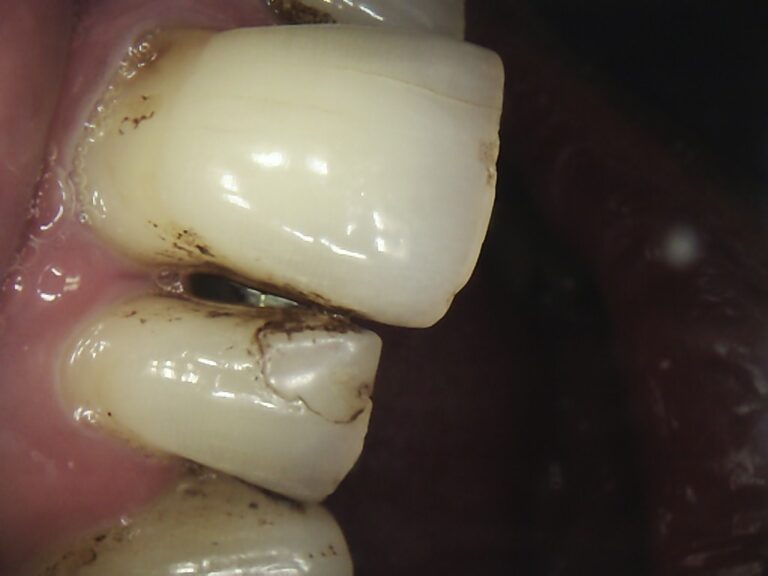 Cavity Vs Stain Whats The Difference Web Dmd 