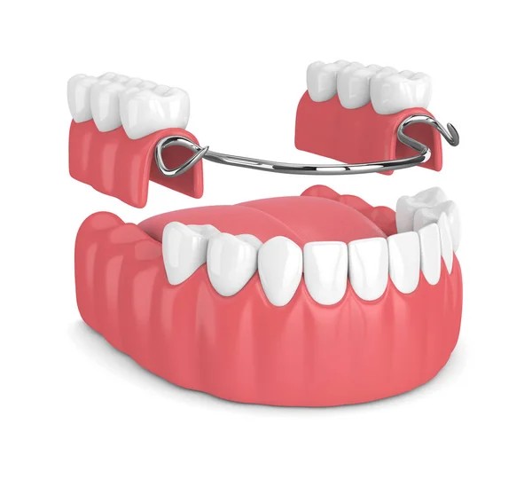 Removable Partial Denture "aka the removable dental bridge"