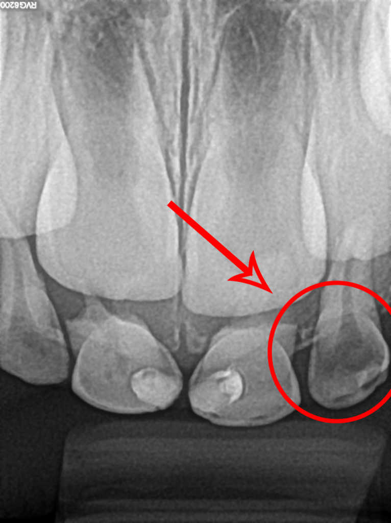 X-Ray of Front Tooth Cavity