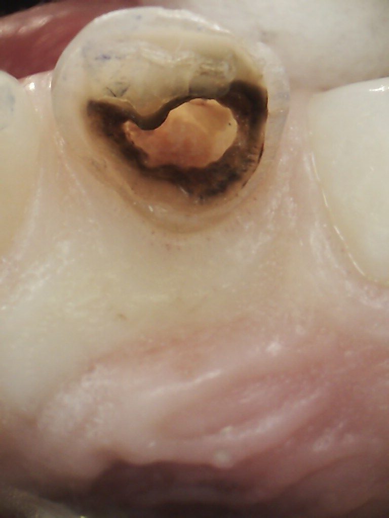 Birds Eye View of Front Tooth Cavity