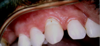 Tooth Decay: Enamel Demineralization
