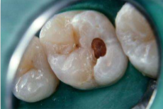 Tooth Decay: Dentin Decay