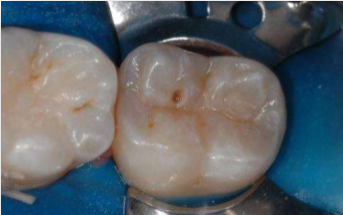 Tooth Decay: Enamel Decay