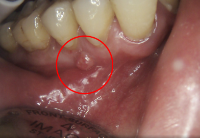 Tooth Decay: Abscess