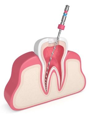 Cleaning and Shaping Tooth with Dental File