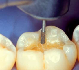 Preparing a Tooth for a Filling