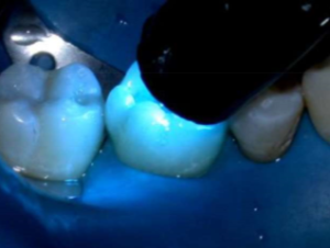 Curing a Resin Modified Glass Ionomer Filling