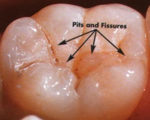 Dental Pits and Fissures