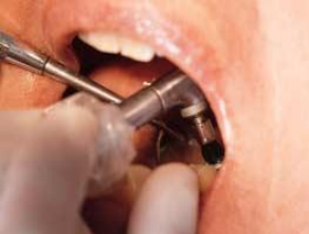 Cleaning Tooth for Dental Sealant