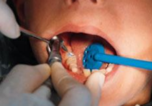 Adjusting Occlusion for Sealant