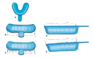 Fluoride Trays for Gels and Foams