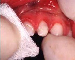 Drying Teeth Before Application of Fluoride Varnish