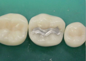 Amalgam Fillings Web Dmd