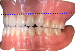 Complete Dental Denture
