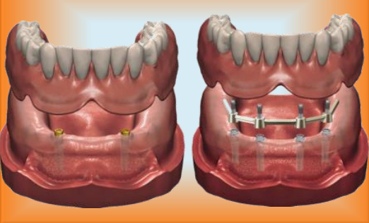 Implant-Retained Overdentures