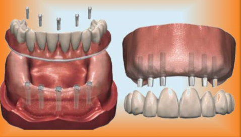 Implant-Supported Fixed Dentures