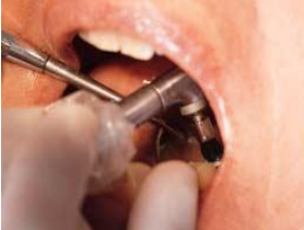 Dental Polishing