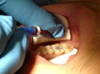 Application of Acid Etch to Tooth