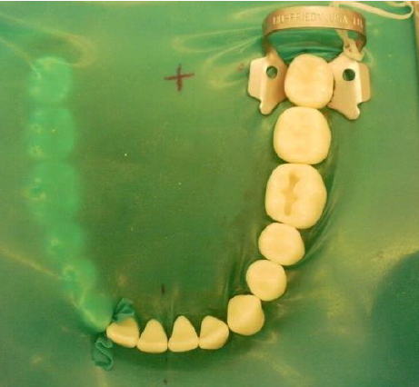 Complete Rubber Dam (Posterior Teeth)