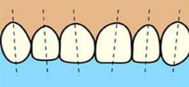 Properly Aligned Tooth Axis