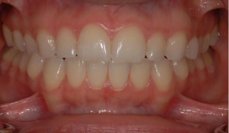 Proper Interdental Closure