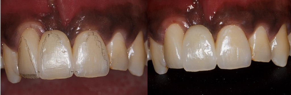 Tooth Surface Texture