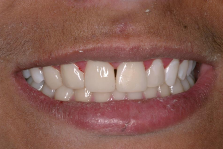 Diastema in Smile