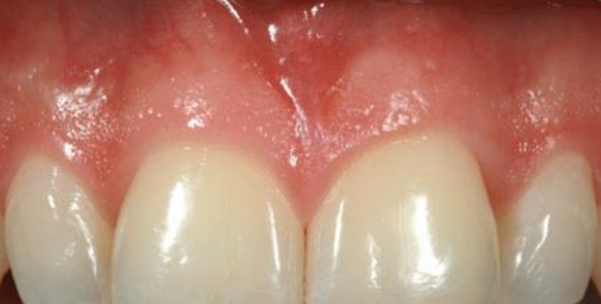 Healthy Gingiva