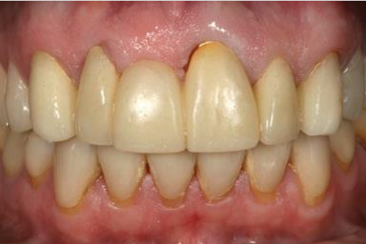 Asymmetry in Gingiva