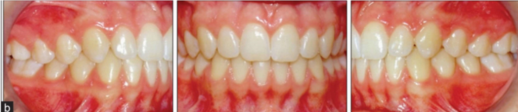 Normal Dental Occlusion