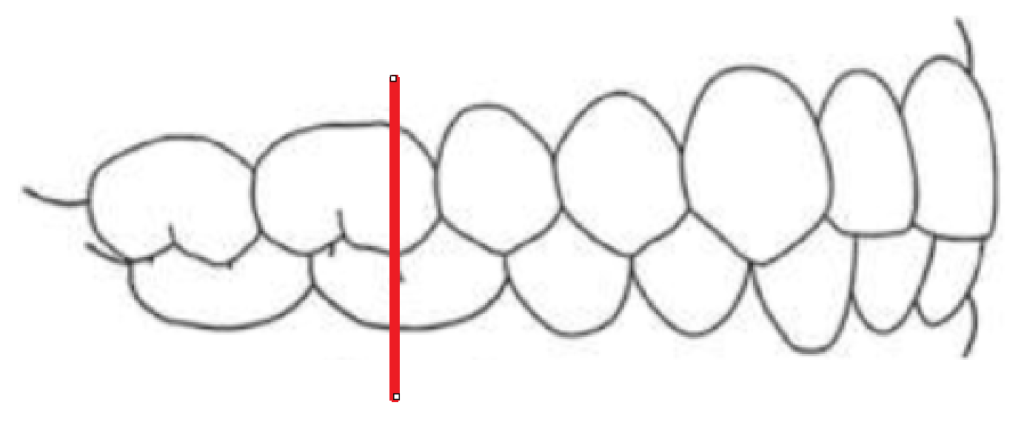 Normal Occlusion