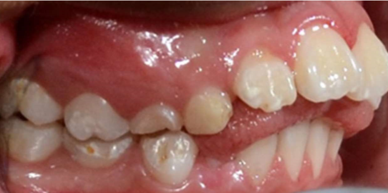 Class II Division I Malocclusion