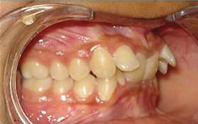 Class II Division II Malocclusion