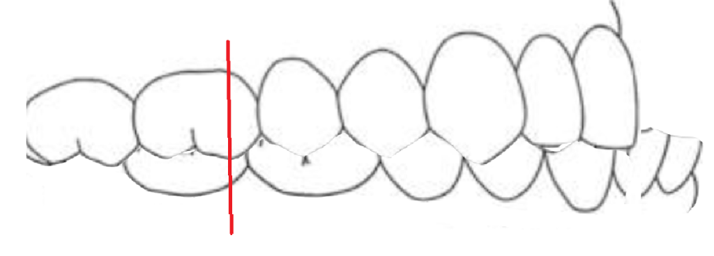 Class III Malocclusion