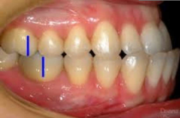 Class III Malocclusion