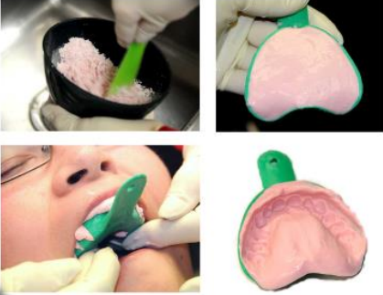 Dental Alginate Impression