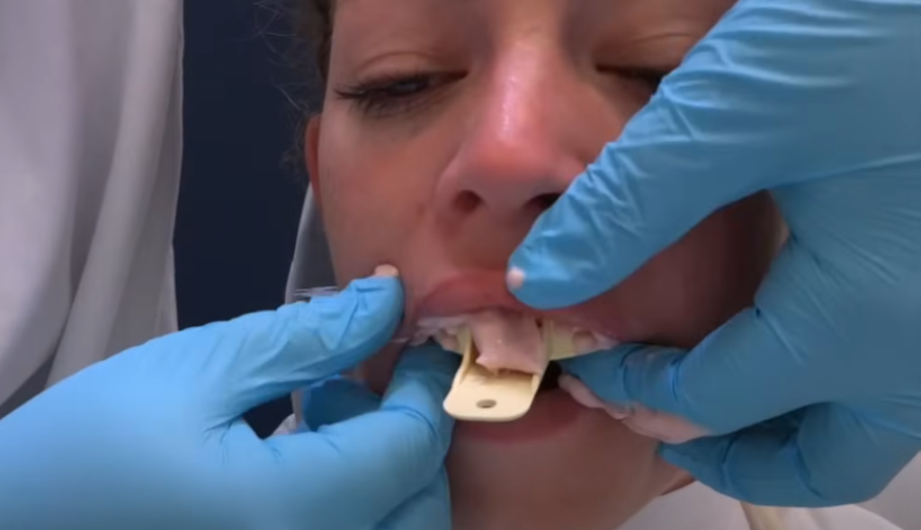 Placing Tray in Patient's Mouth