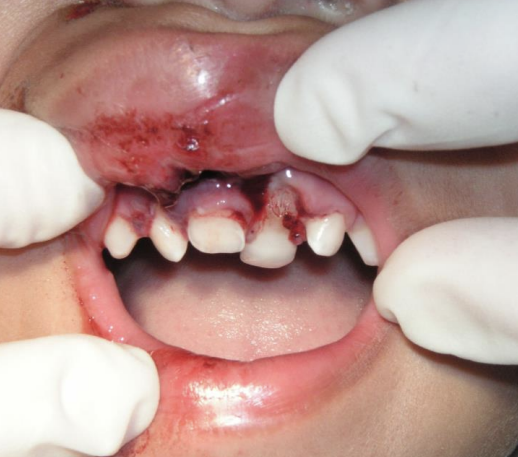 Dental Trauma (Primary Teeth)